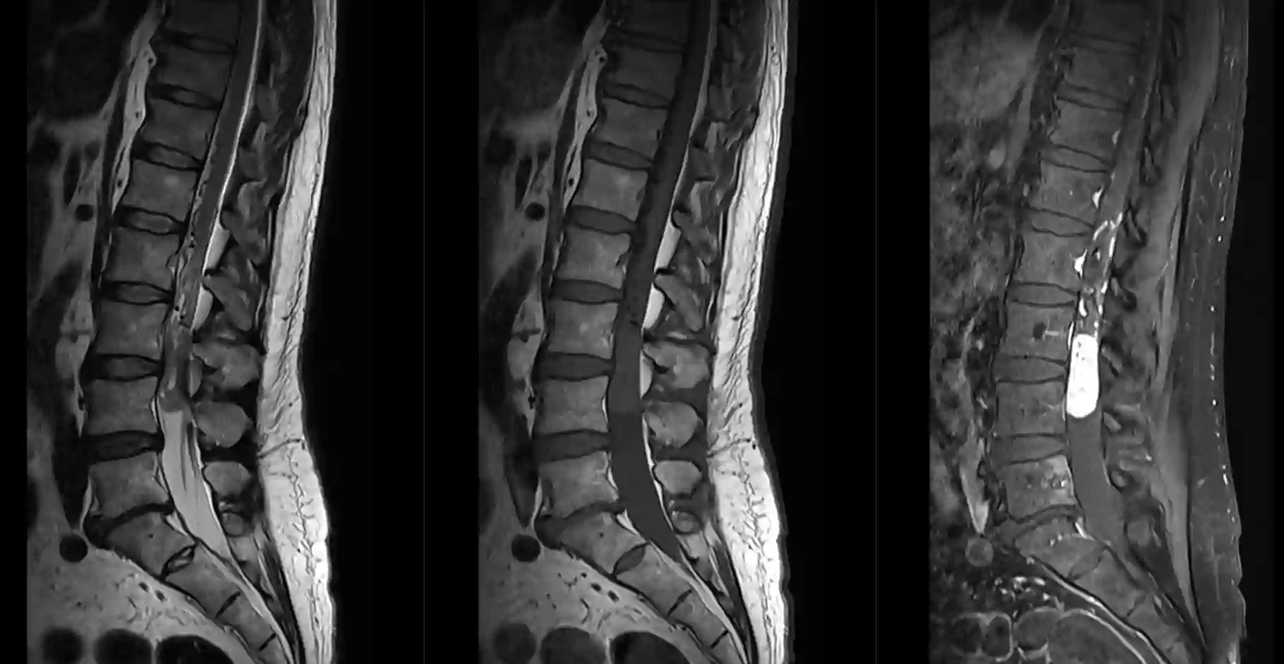 lumbales Paragangliom MRI