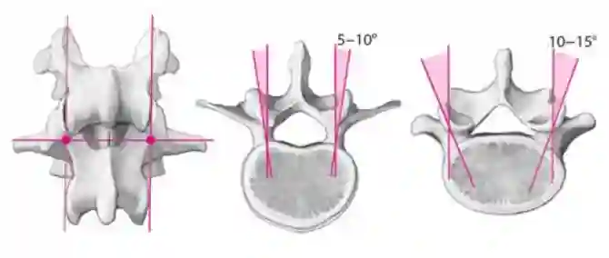 Schematisch Pedikelschraubeneintrittspunkt