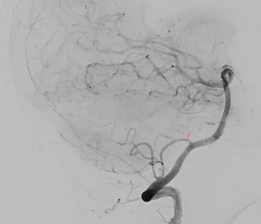 PICA Angiographie lateral