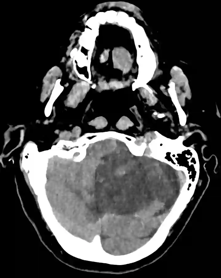 Linksseitiger PICA Infarkt im axialen CT Bild