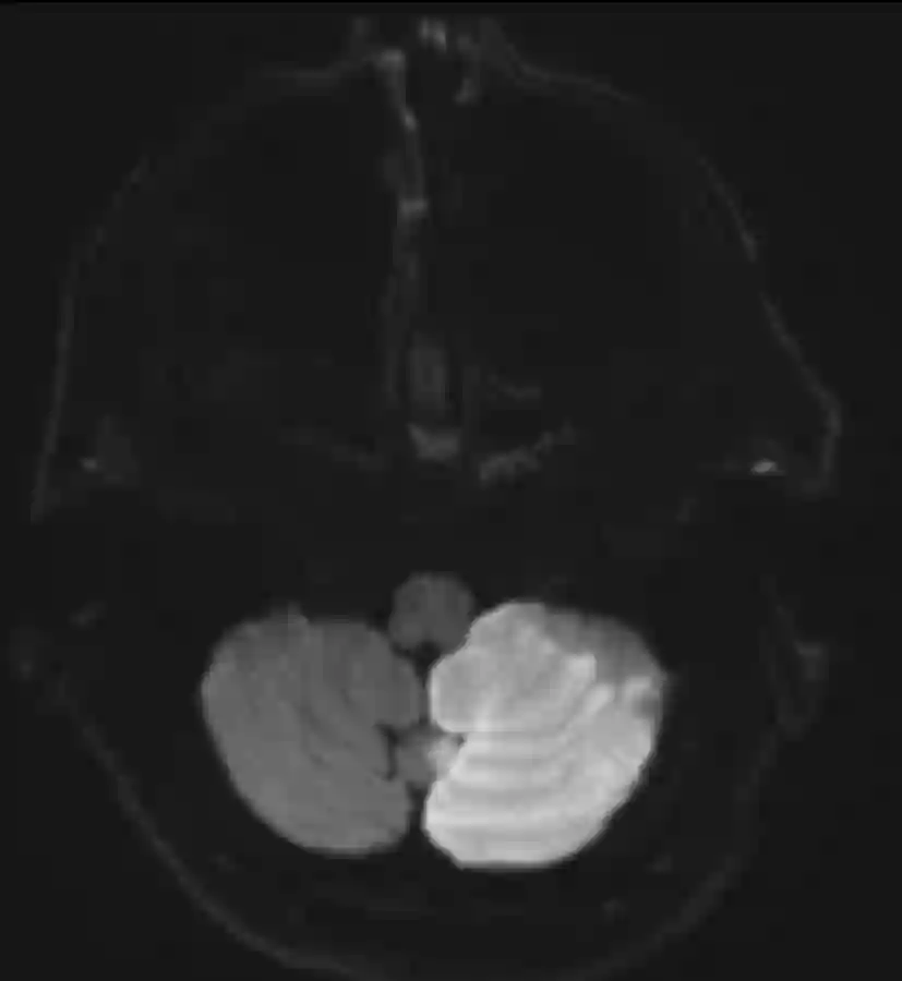 Linksseitiger PICA Infarkt im Kleinhirn im axialen MRI Bild.