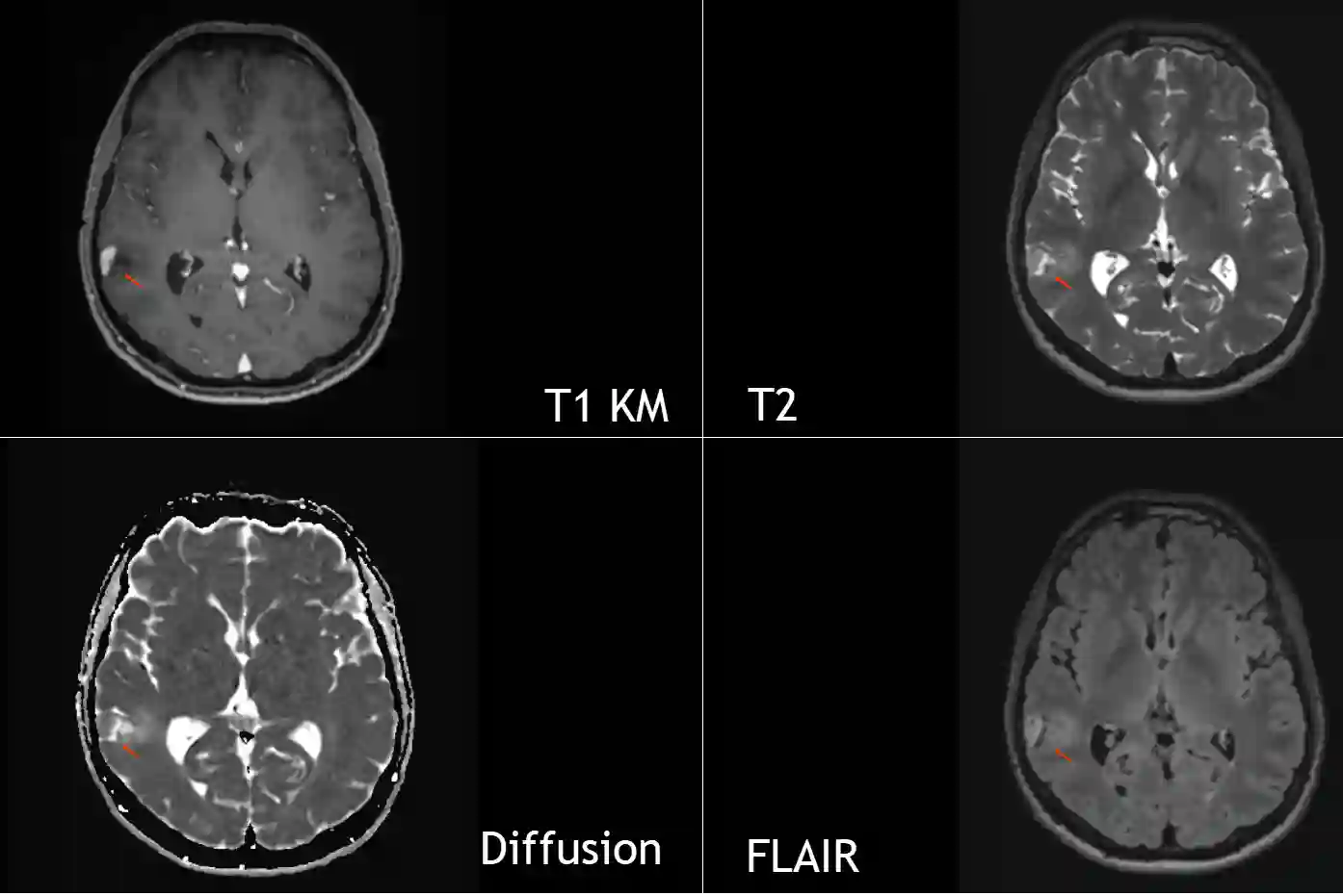 Pilozytisches Astrozytom im MRI