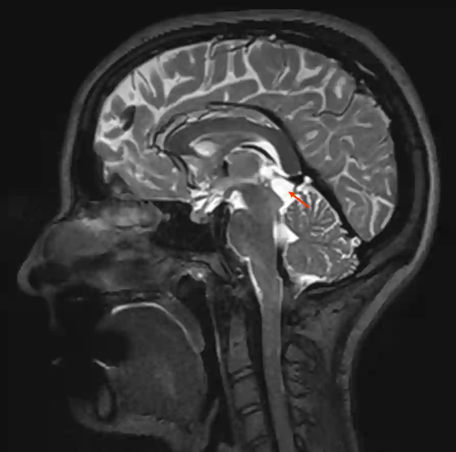 Pinealiszyste MRI