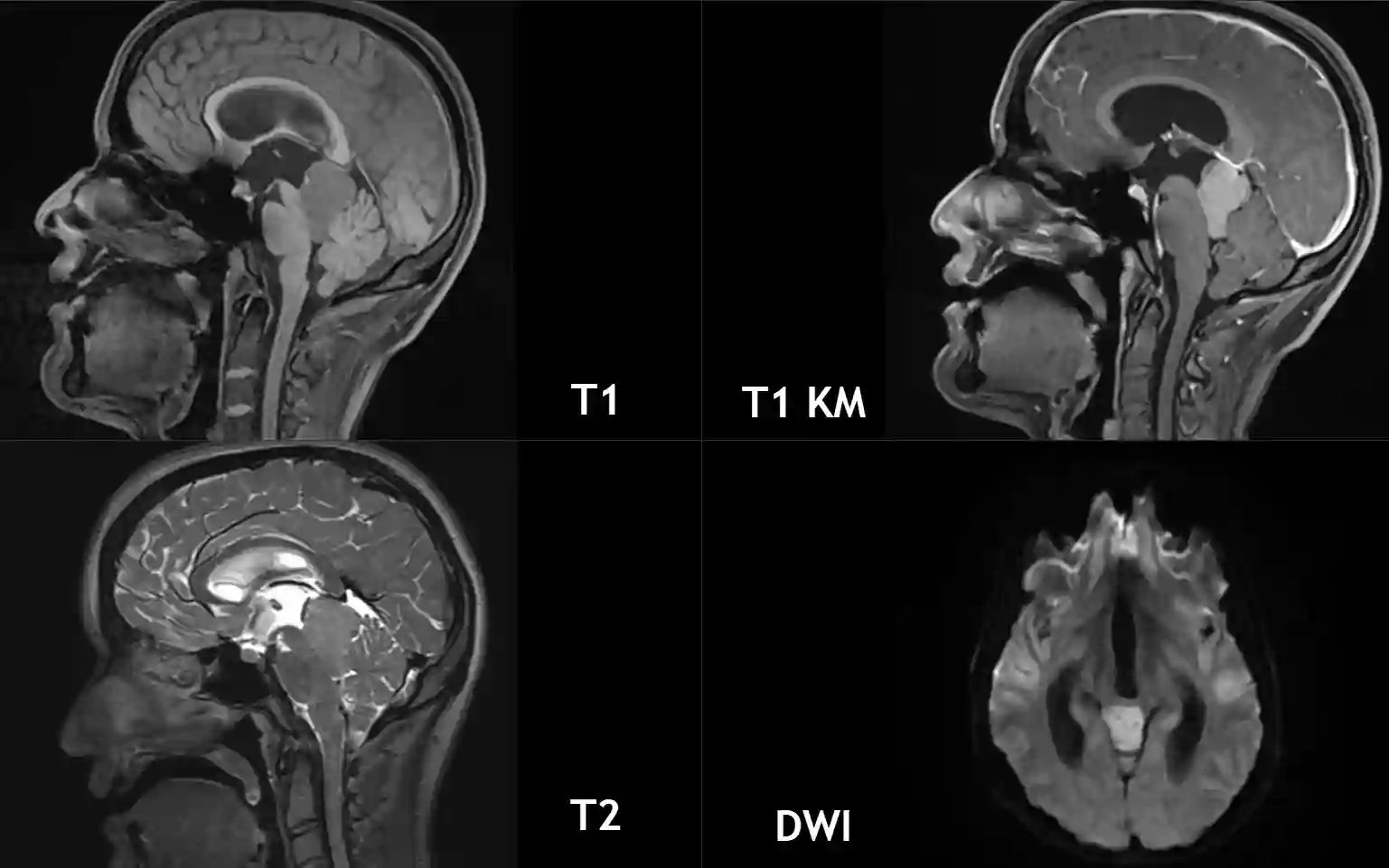 MRI Bildgebung bei einem Pineoblastom