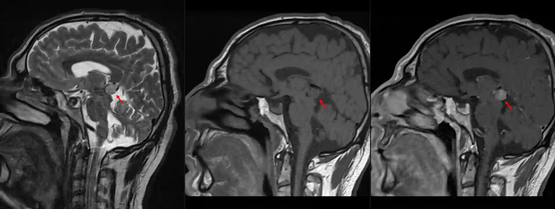 Pineozytom im MRI