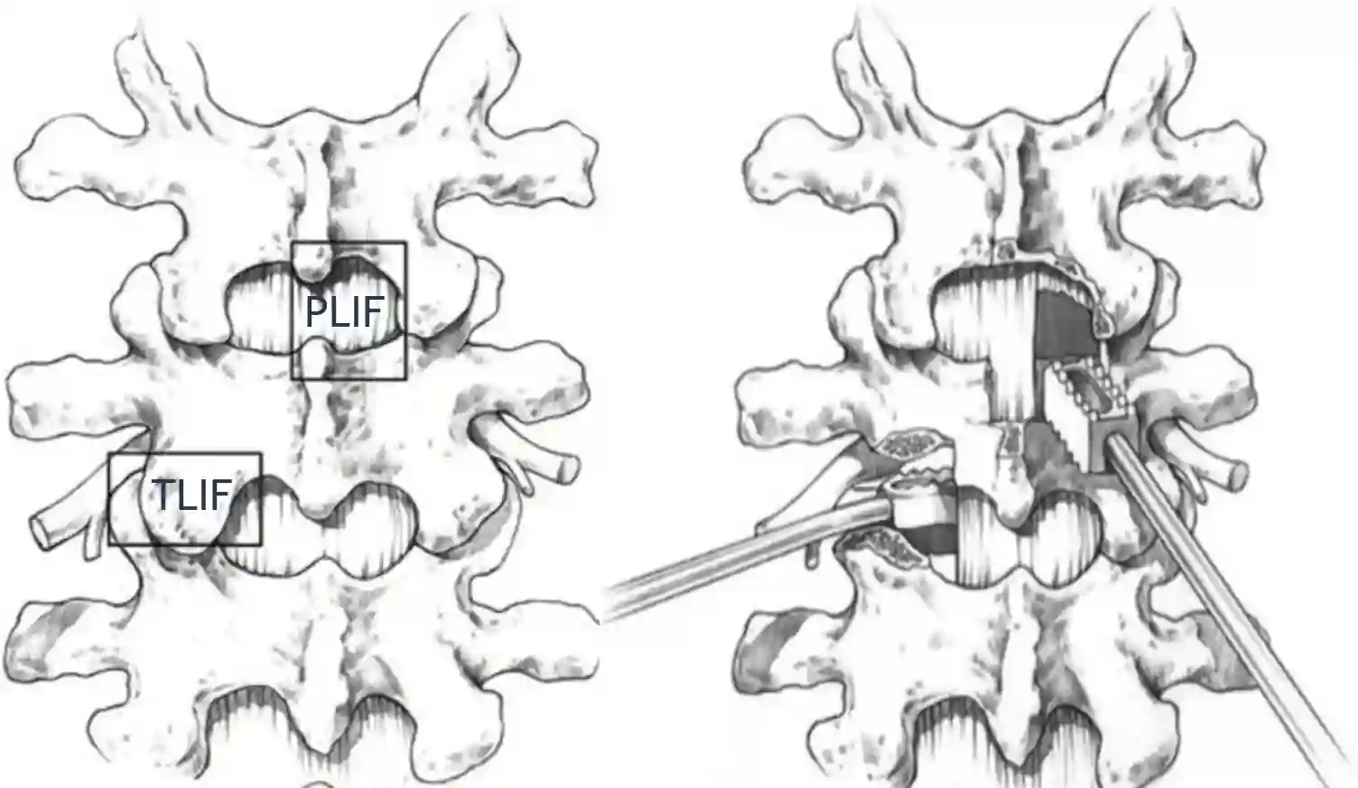 TLIF und PLIF schematisch
