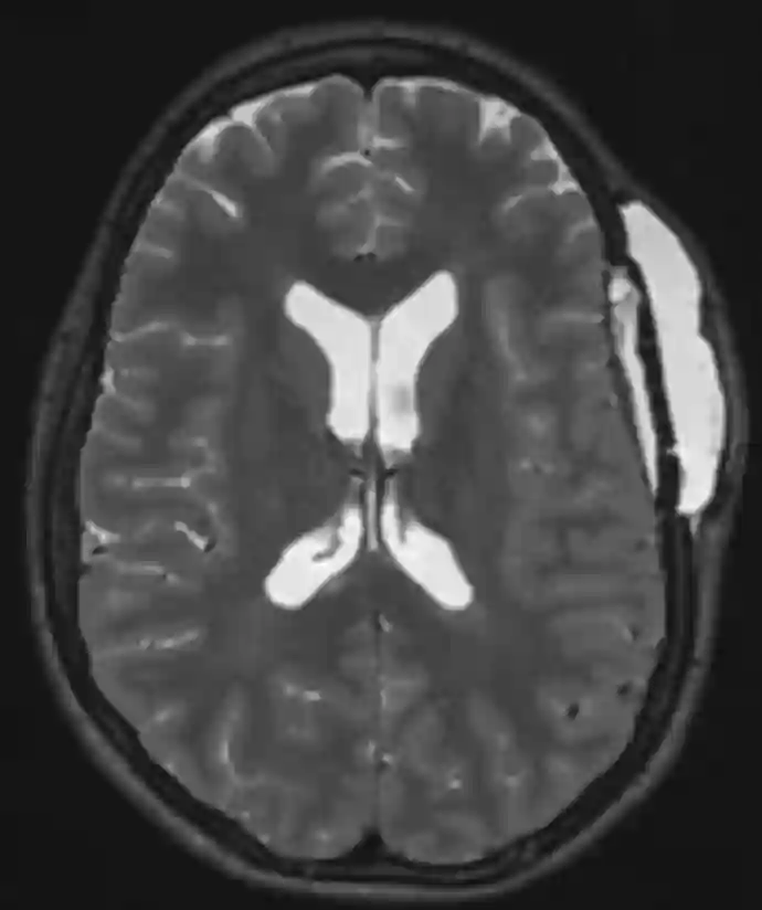 Liquorkissen MRI