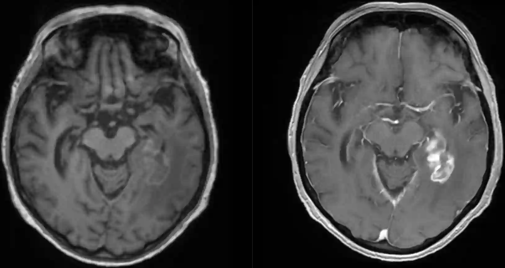Primäres ZNS Lymphom im MRI