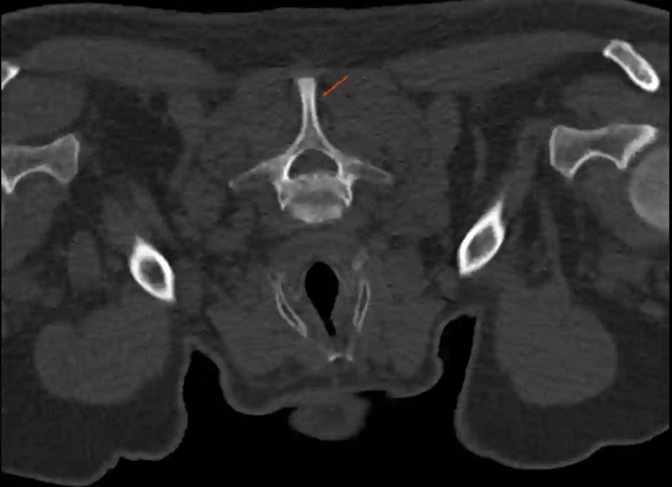Abbildung eines Processus spinosus im axialen CT
