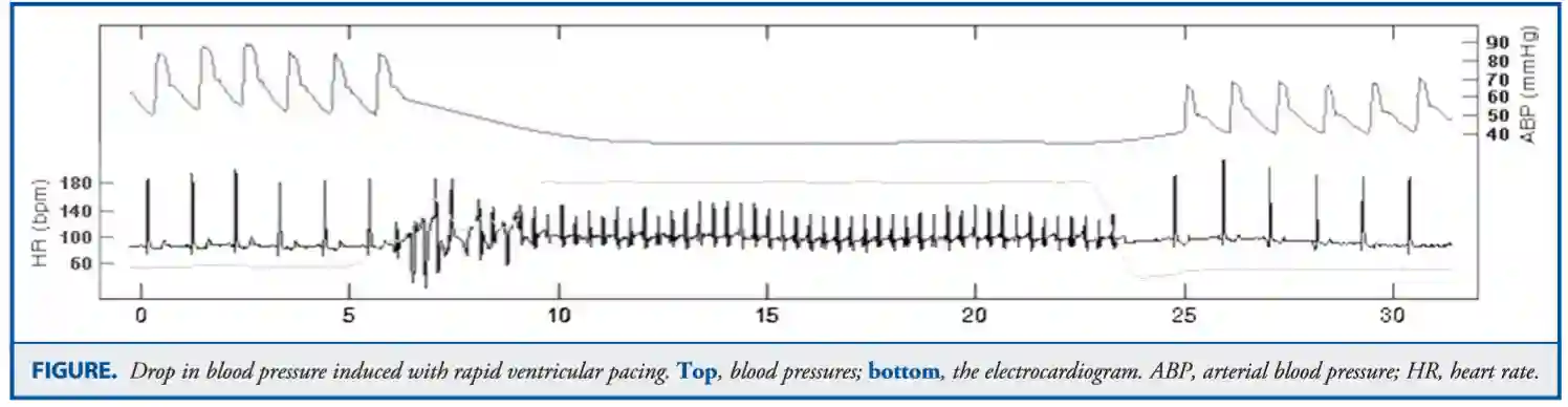 Rapid intraventricular pacing