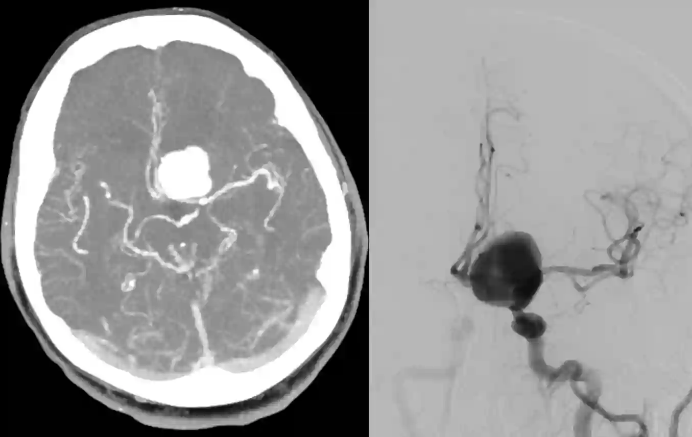 Riesenaneurysma der Arteria carotis interna in der CT-Angiographie und Angiographie