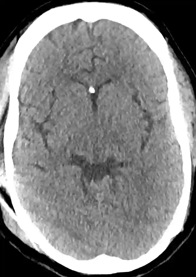 CT Schlitzventrikelsyndrom mit VP-Shunt