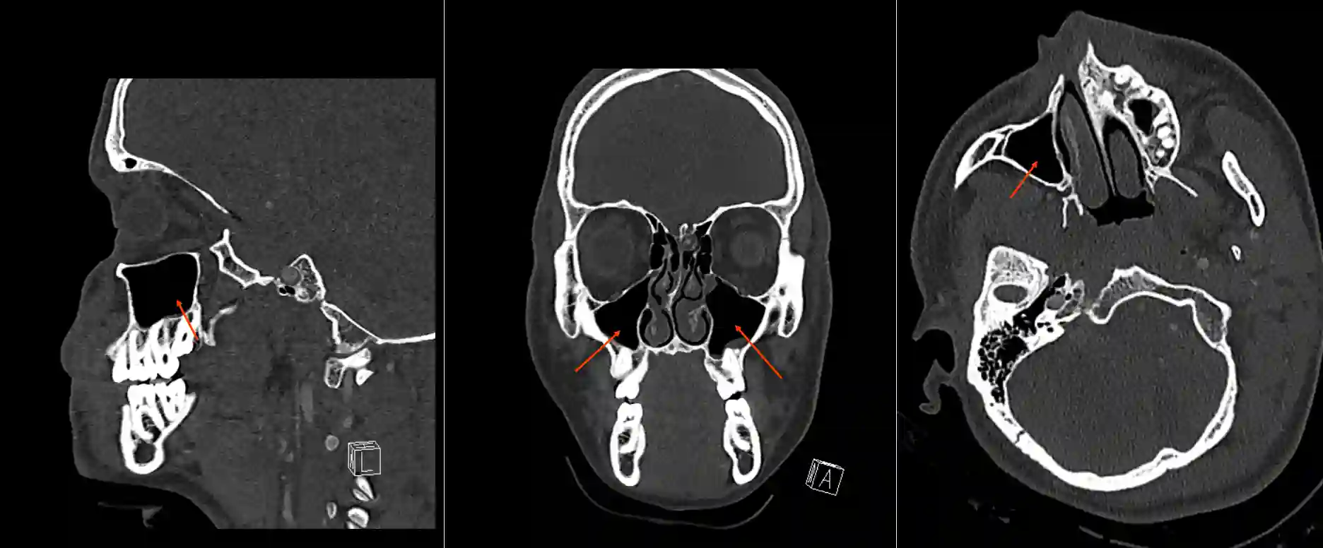 Sinus maxillaris im CT