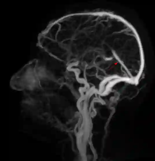 Sinus rectus MR-Angiographie