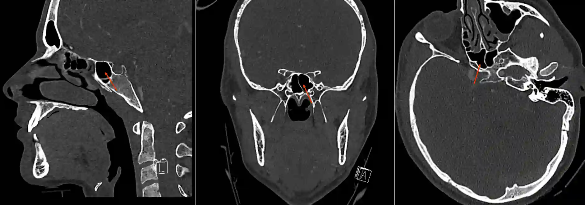 Sinus sphenoidalis CT