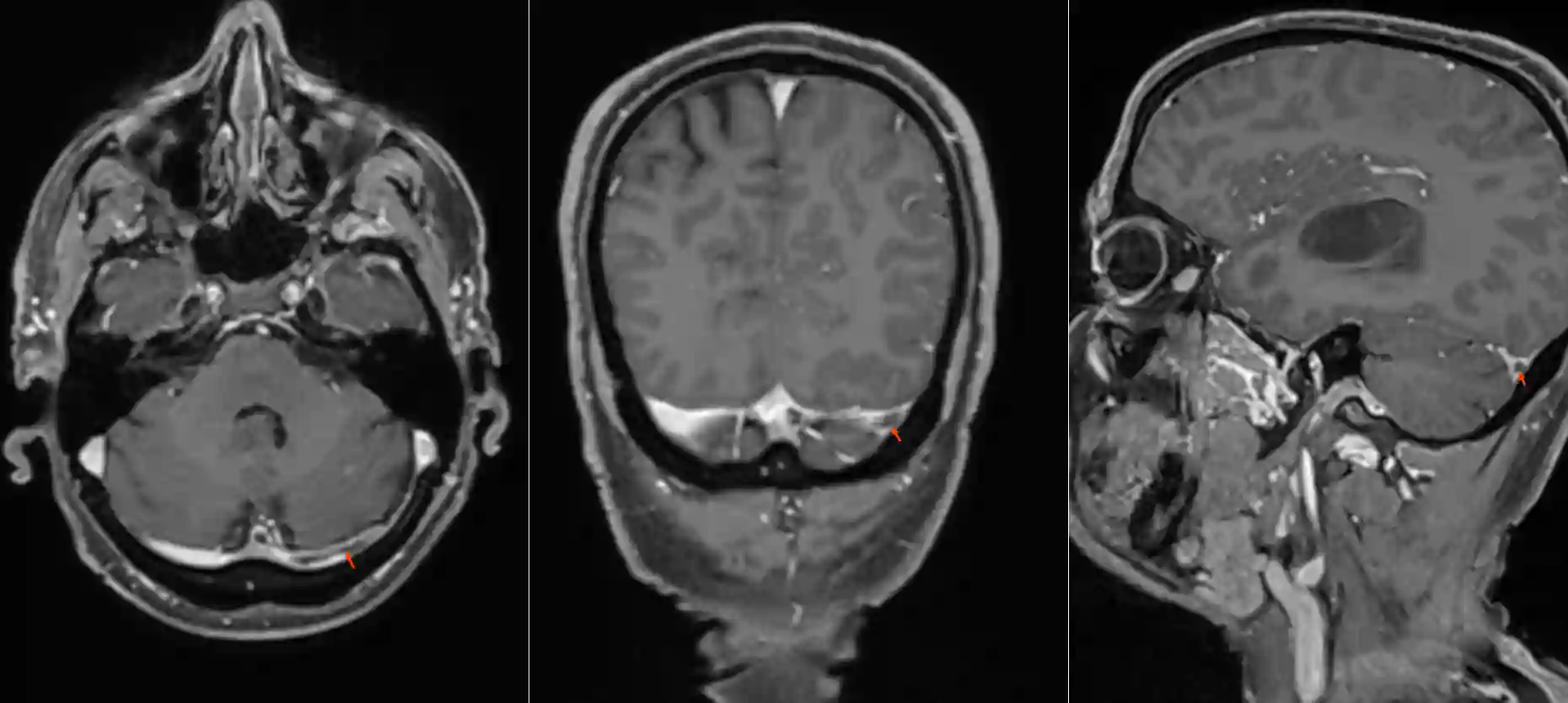 Sinusvenenthrombose im MRI