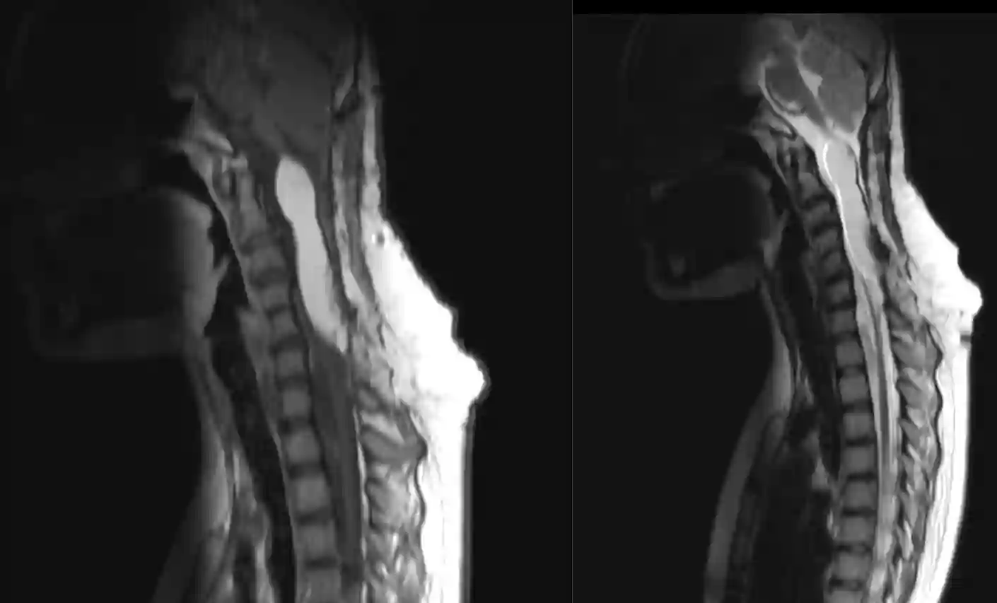 Spinales Lipom im MRI