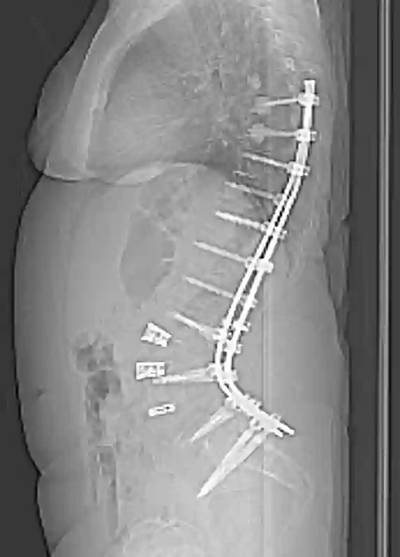 Spondylodese Röntgen