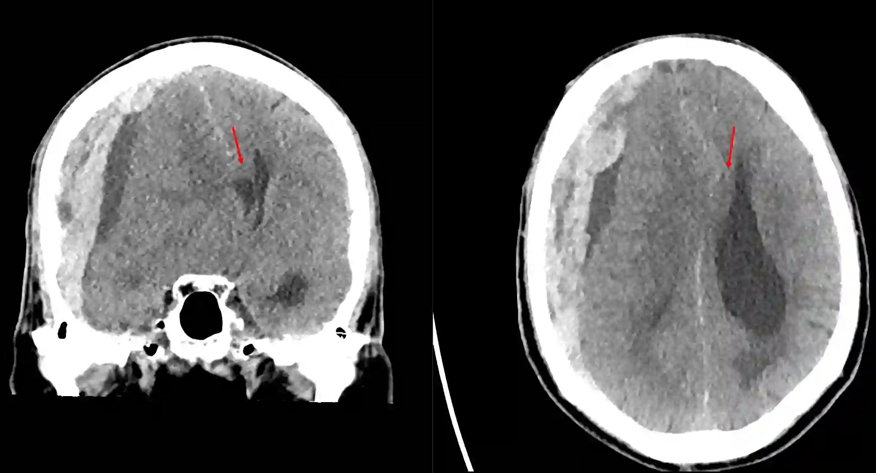 Subfalcine Herniation
