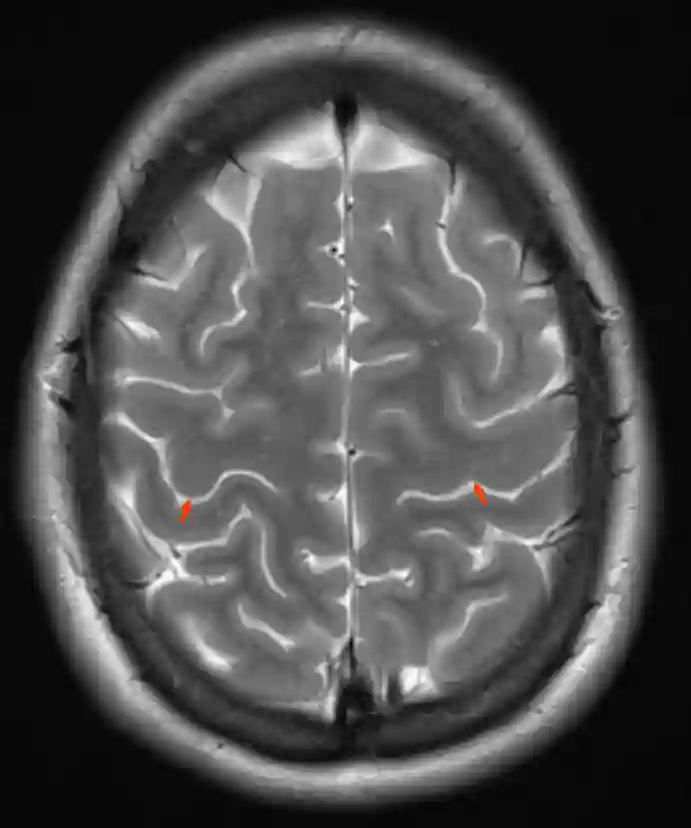 Sulcus centralis MRI