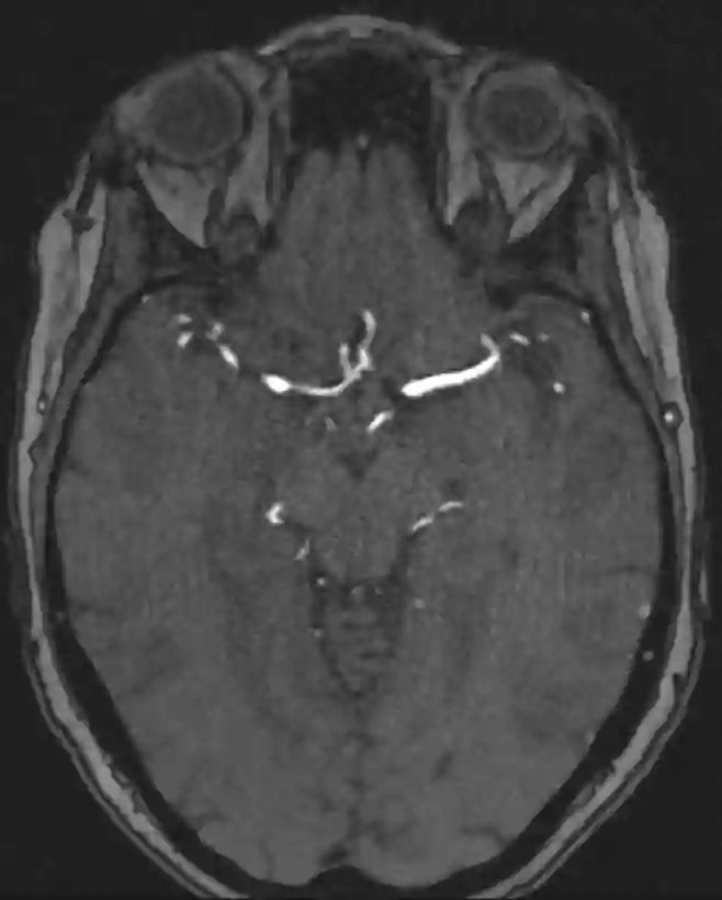 MRI TOF Sequenz