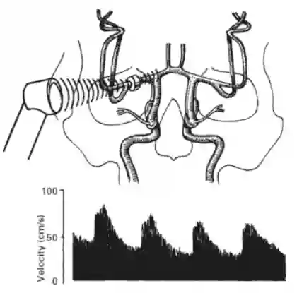 Schematische Darstellung einer transkraniellen Dopplersonografie