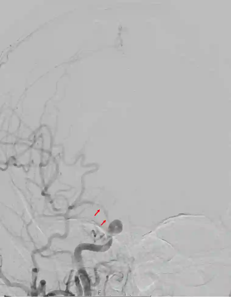 Angiographie Vasospasmus