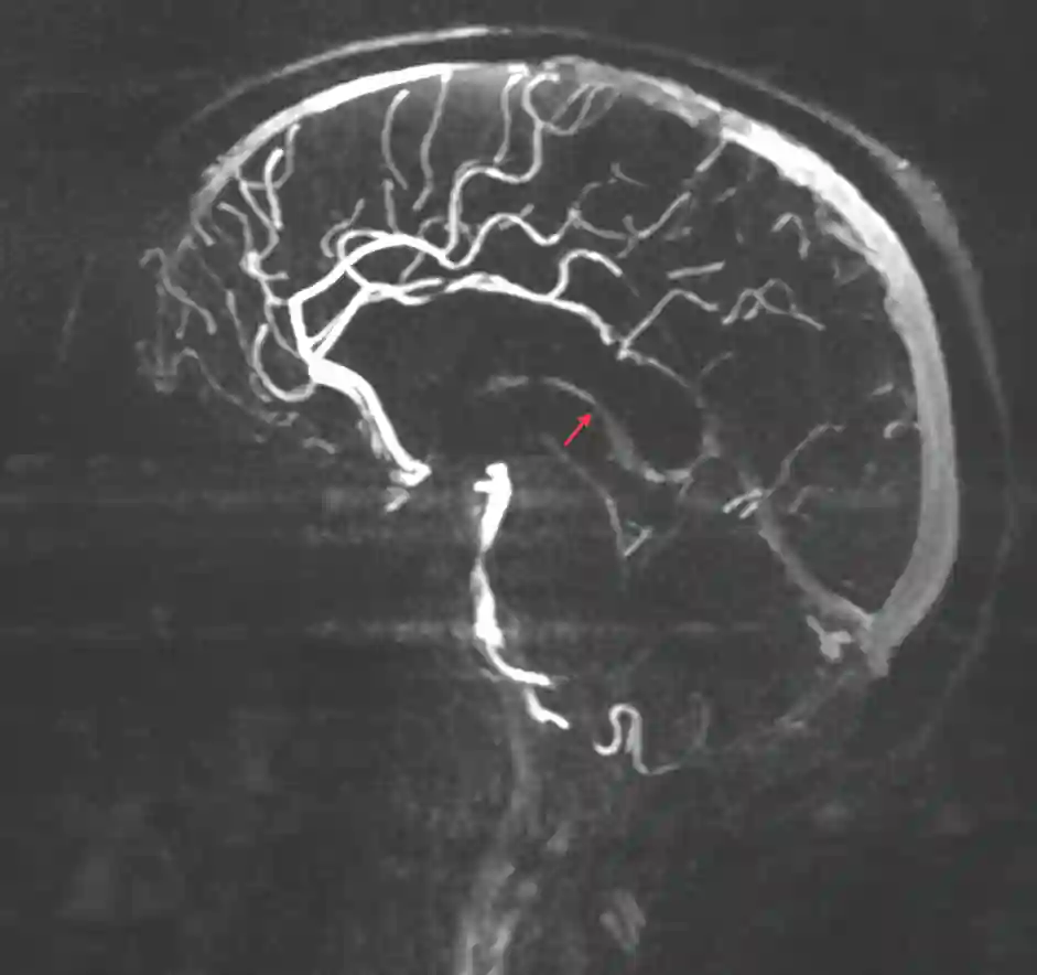 Vena cerebri interna im MRI