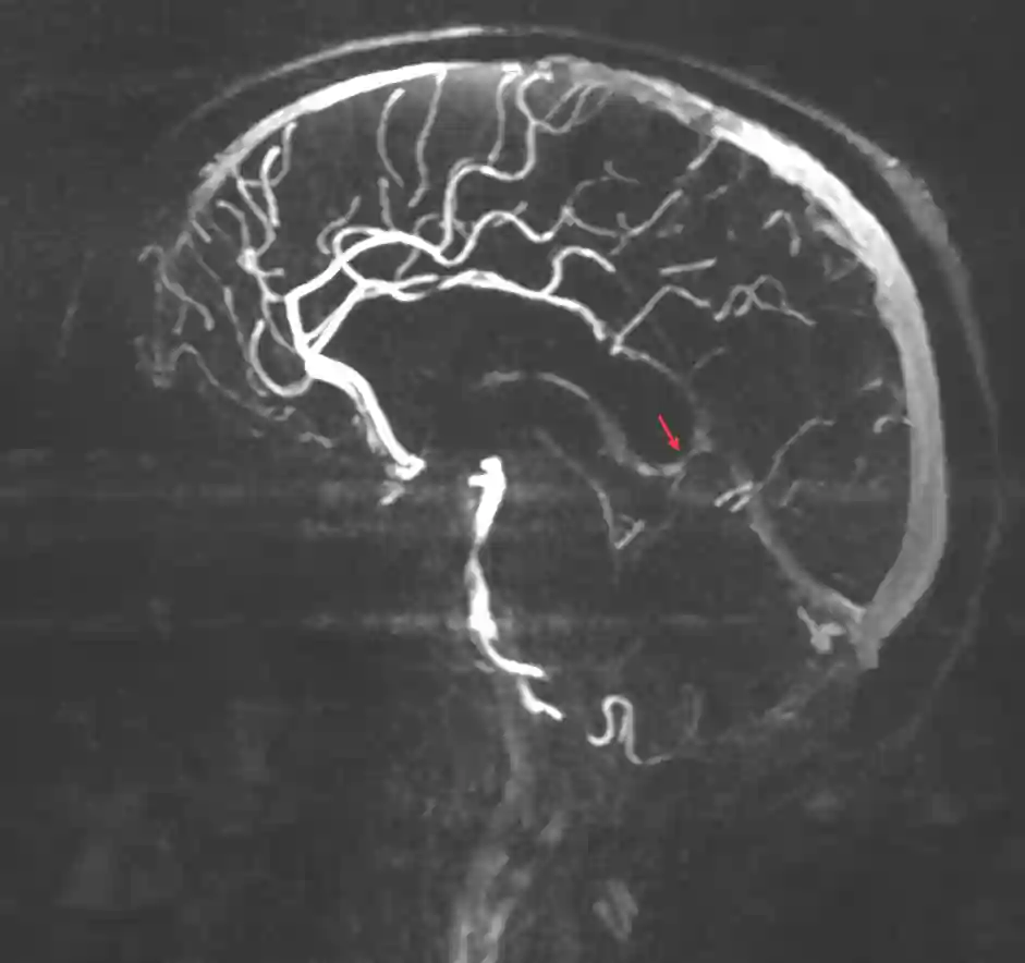 Vena Galen im MRI