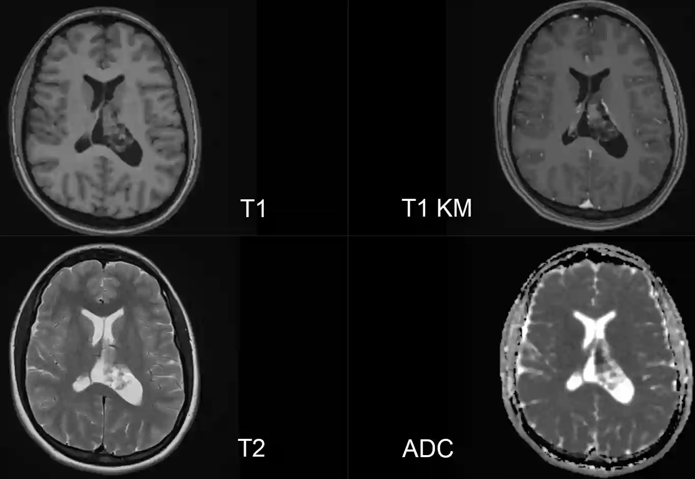Zentrales Neurozytom WHO Grad II MRT