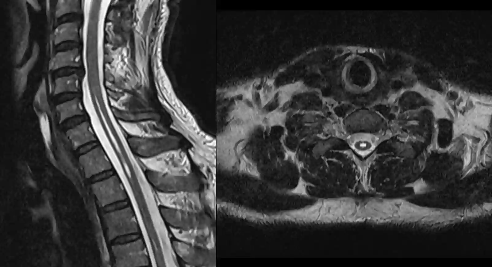 Syringomyelie im MRI