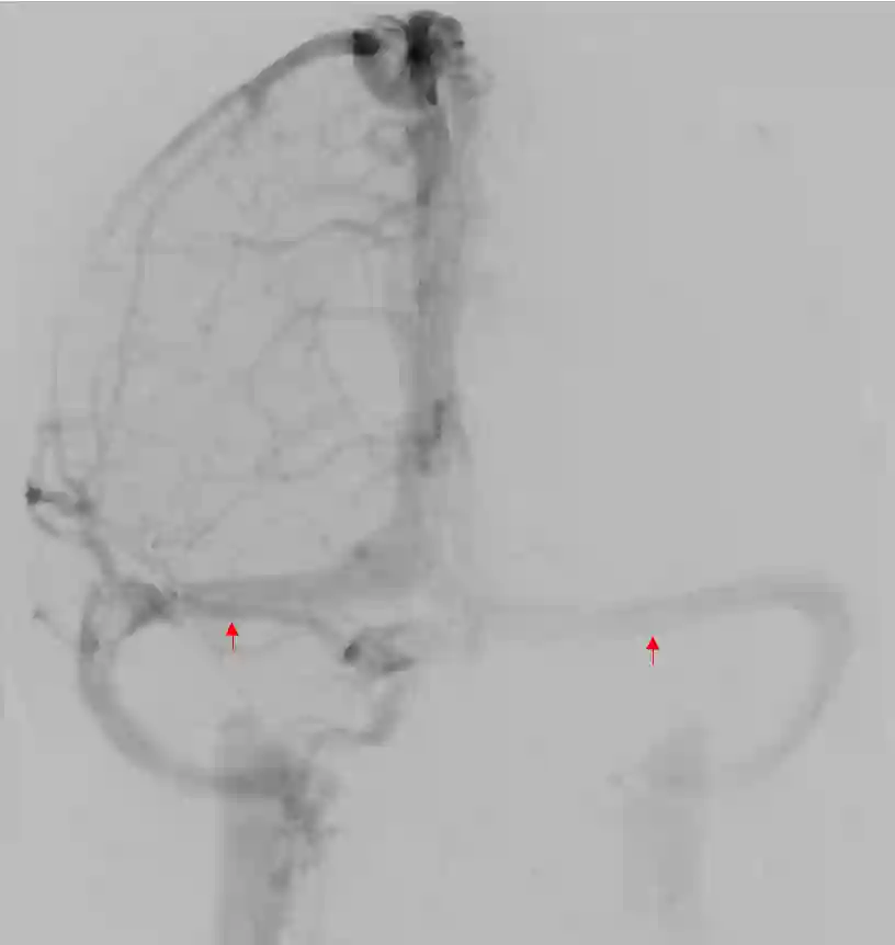 Sinus transversus Angiographie